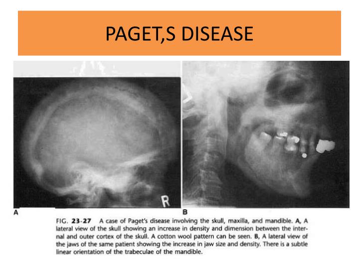 PPT BONE DISEASES OF JAWS PowerPoint Presentation ID4809422