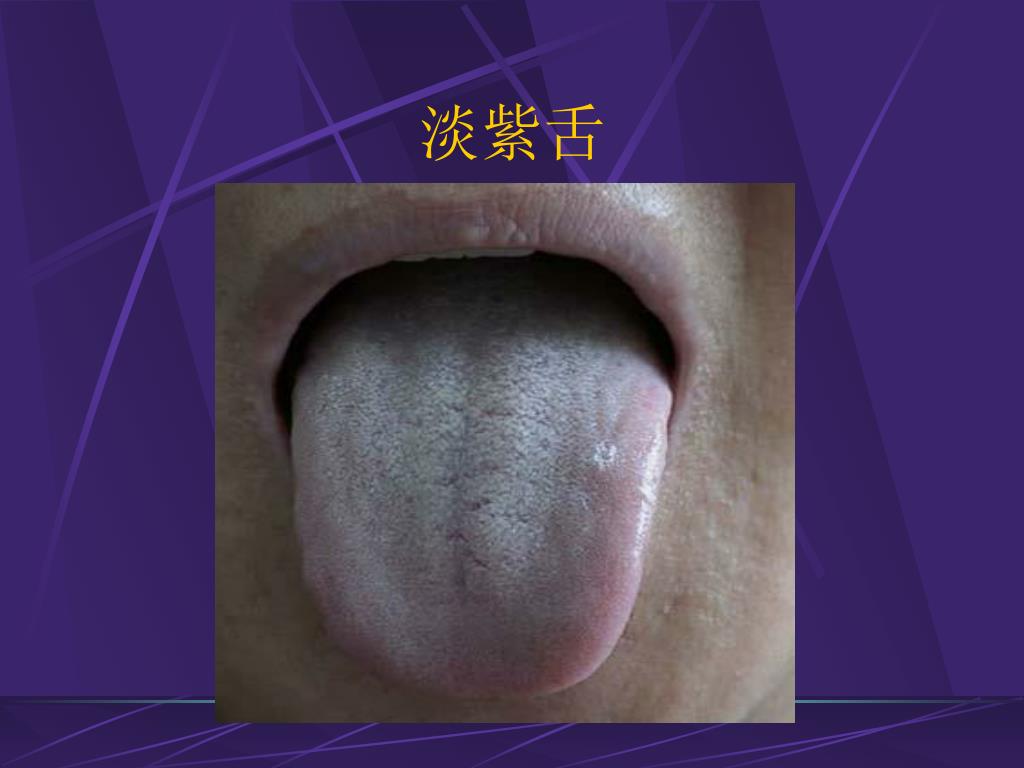 舌头的前世今生——望舌质——望舌色（紫舌） - 知乎