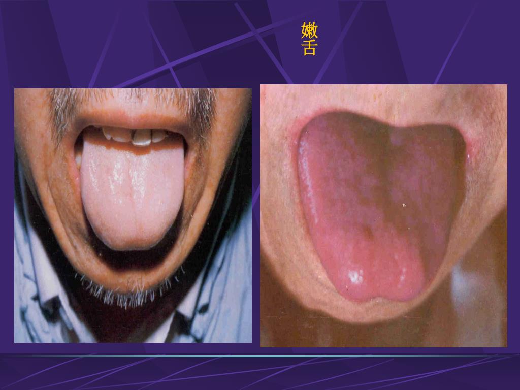 淡紫舌舌象分析 - 知乎