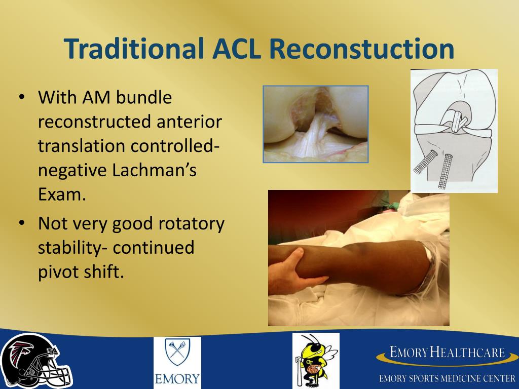 ppt-acl-reconstruction-the-anatomic-approach-powerpoint-presentation