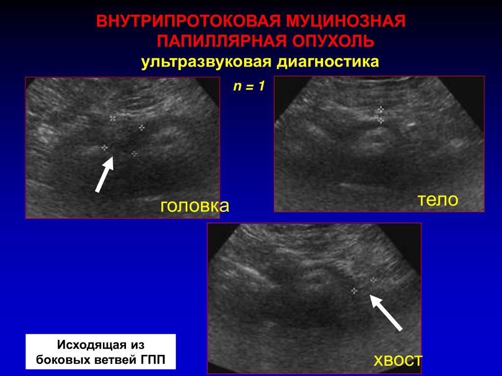 Опухоль поджелудочной железы на узи фото