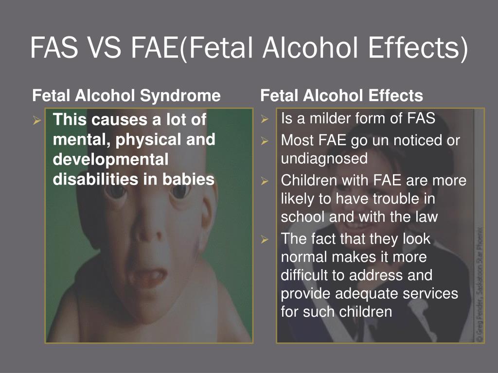 Fetal Alcohol Syndrome Causes And Effects