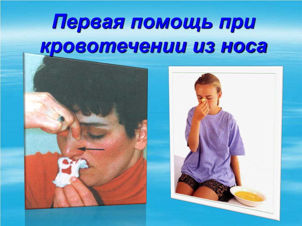 С носовым кровотечением следует. Оказание первой помощи при носовом кровотечении. Оказание первой помощи при кровотечении из носа. При кровотечении из носа. При носовом кровотечении необходимо.