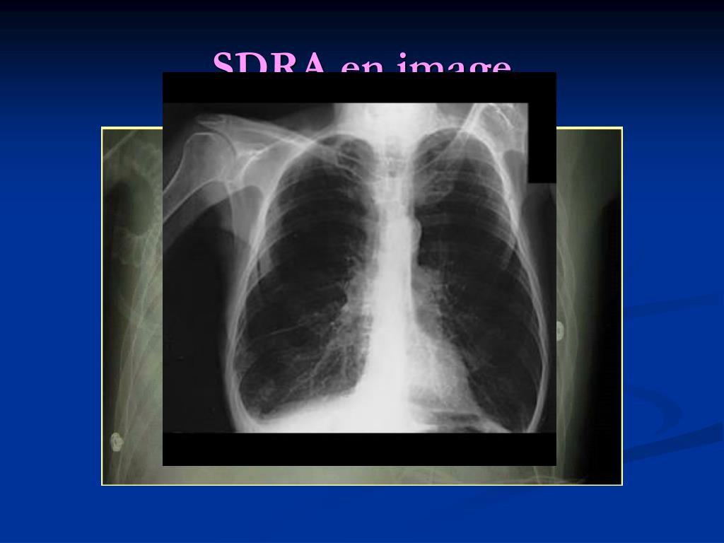 PPT Prise En Charge D un Patient En SDRA Par Oxyg nation ppt-prise-en-charge-d-un-patient-en-sdra-par-oxyg-nation