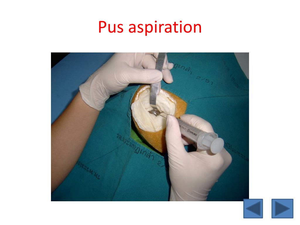 PPT CAI Neurosurgical Operation brain Abscess Resection Virtual 