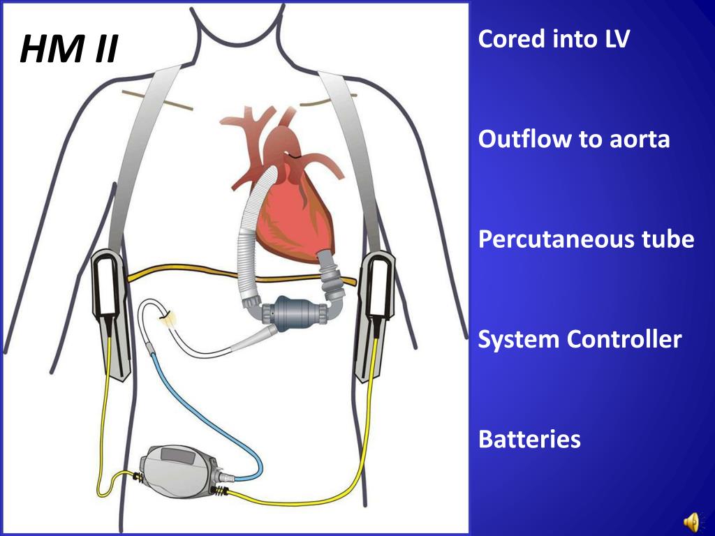 PPT HeartMate II Left Ventricular Assist Device (LVAD) PowerPoint