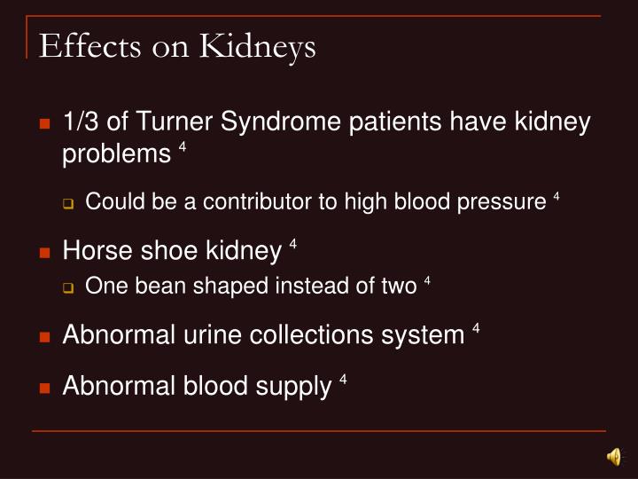 PPT Turner Syndrome PowerPoint Presentation ID4837482