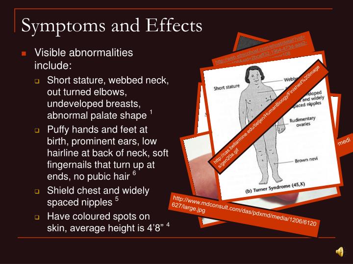 PPT Turner Syndrome PowerPoint Presentation ID4837482