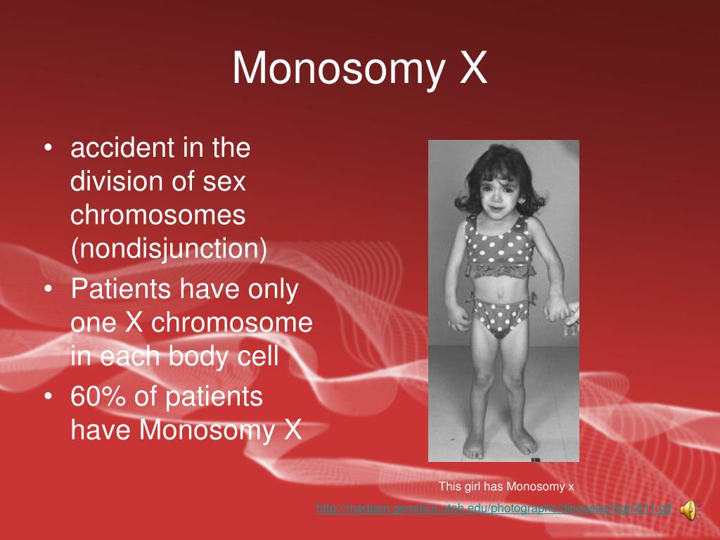 Ppt Turner Syndrome Powerpoint Presentation Free Download Id 4837737
