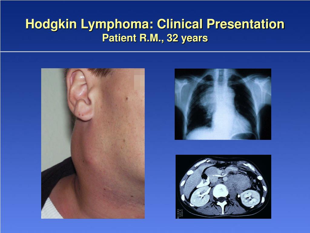 clinical presentation of hodgkin's lymphoma