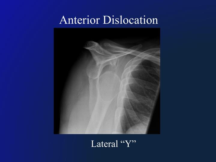 PPT - Shoulder Dislocation PowerPoint Presentation - ID:4841498