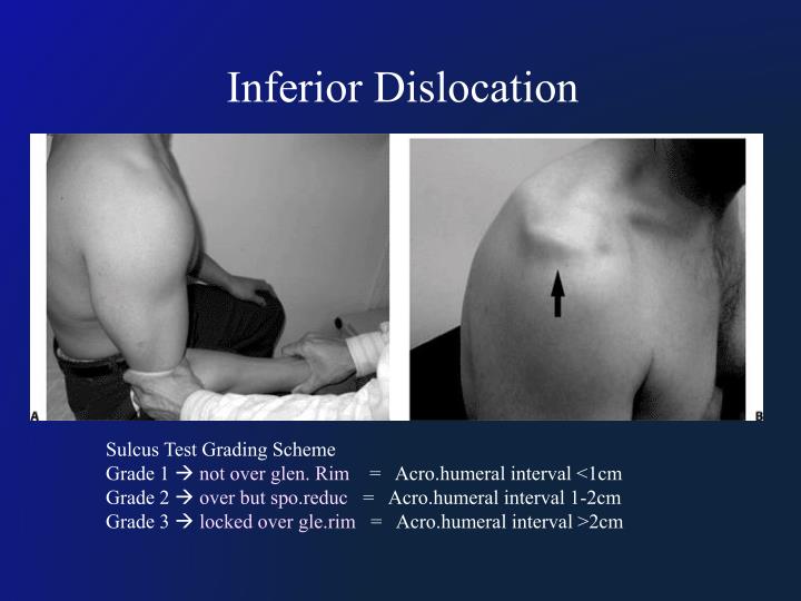 PPT Shoulder Dislocation PowerPoint Presentation ID4841498