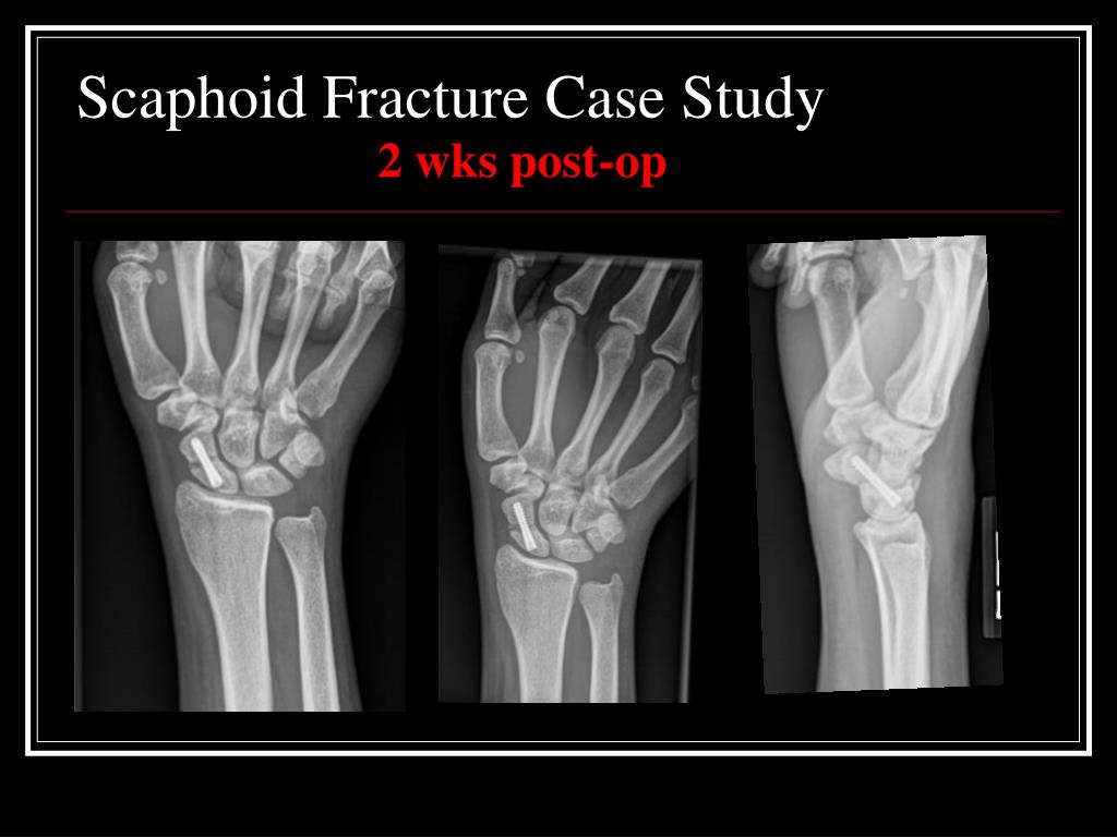 case study on fracture slideshare