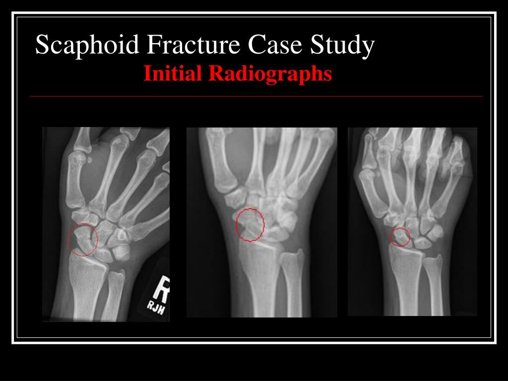 case study on fracture slideshare