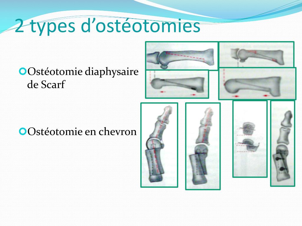 PPT - Hallux valgus par voie mini-invasive PowerPoint Presentation ...
