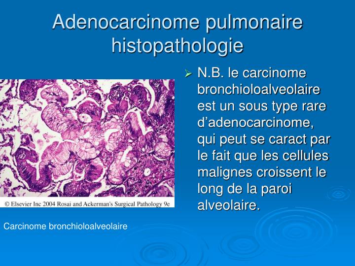 Ppt Cancers Bronchopulmonaires Powerpoint Presentation Id 4847426