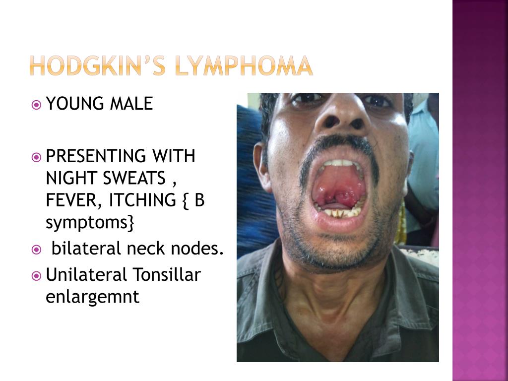 Ppt Cervical Lymphadenopathy Powerpoint Presentation Free Download