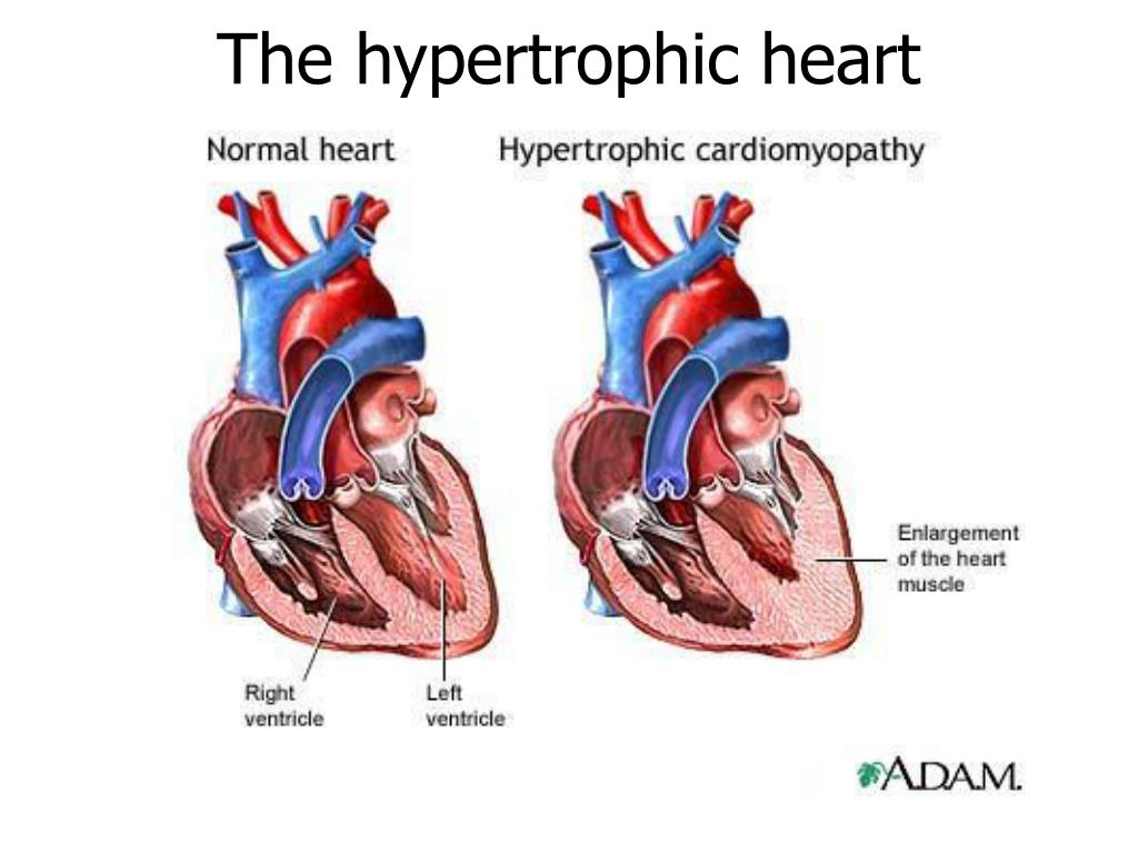 Желудочка сердца расширена. Гипертрофическая кардиомиопатия. Гипертрофической кардиомиопатии. Кардиопатия сердца у детей. Сердце спортсмена и обычного человека.
