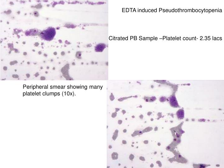 PPT Platelet Counts PowerPoint Presentation ID4855218