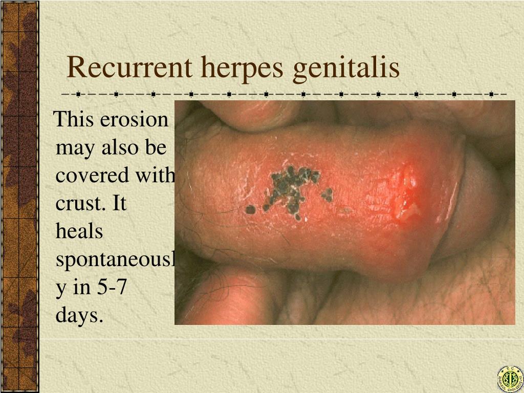 Recurrent herpes genitalis.