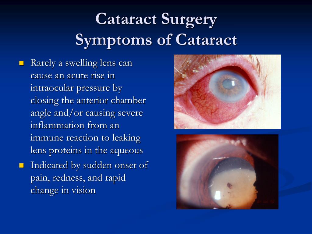 Cataracts Surgery Symptoms Causes Types Hot Sex Picture