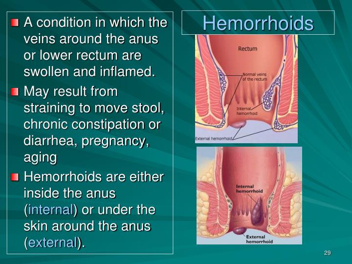 Best of Swelled tissue around anus around anus tissue Swelled