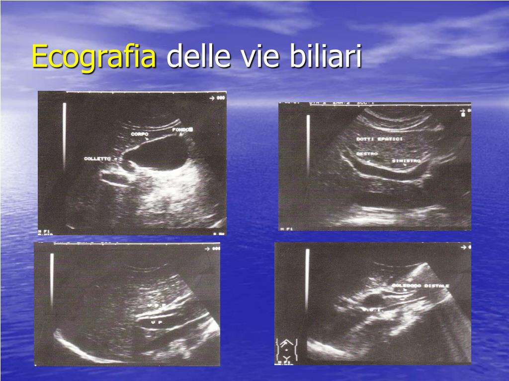 Ecocolordoppler Fegato E Vie Biliari PPT - L’Ecografia nell’ Ittero Ostruttivo PowerPoint Presentation, free