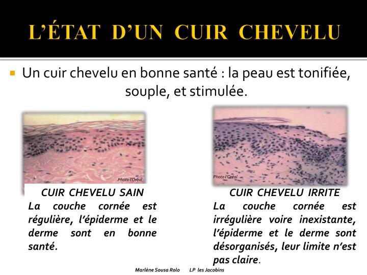 PPT ANOMALIES DU CUIR CHEVELU PowerPoint Presentation ID4905276