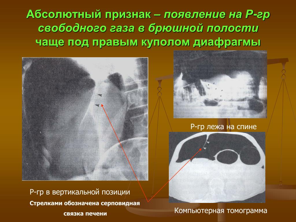 Симптом появления. Свободный ГАЗ В брюшной полости. Свободный ГАЗ В брюшной полости определяется. Свободный ГАЗ В брюшной полости на кт. Свободный ГАЗ В брюшной полости на рентгенограмме.