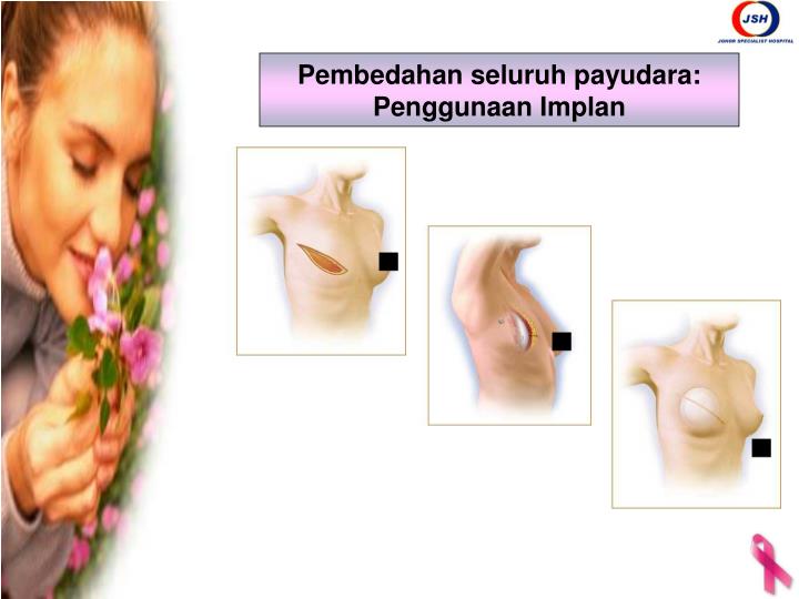 PPT - Kanser Payu Dara (Breast Cancer) PowerPoint 