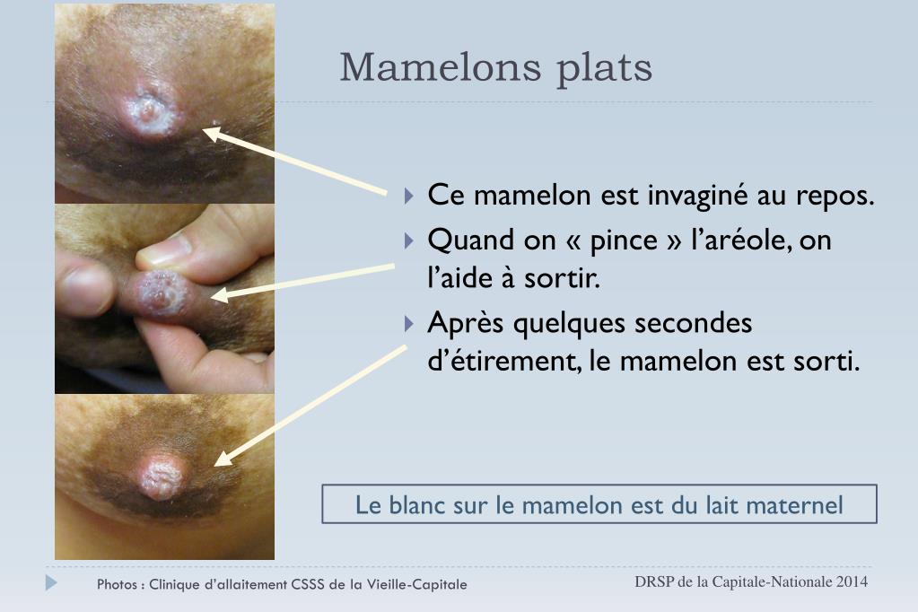 PPT - Mamelons plats et invaginés PowerPoint Presentation, free ...