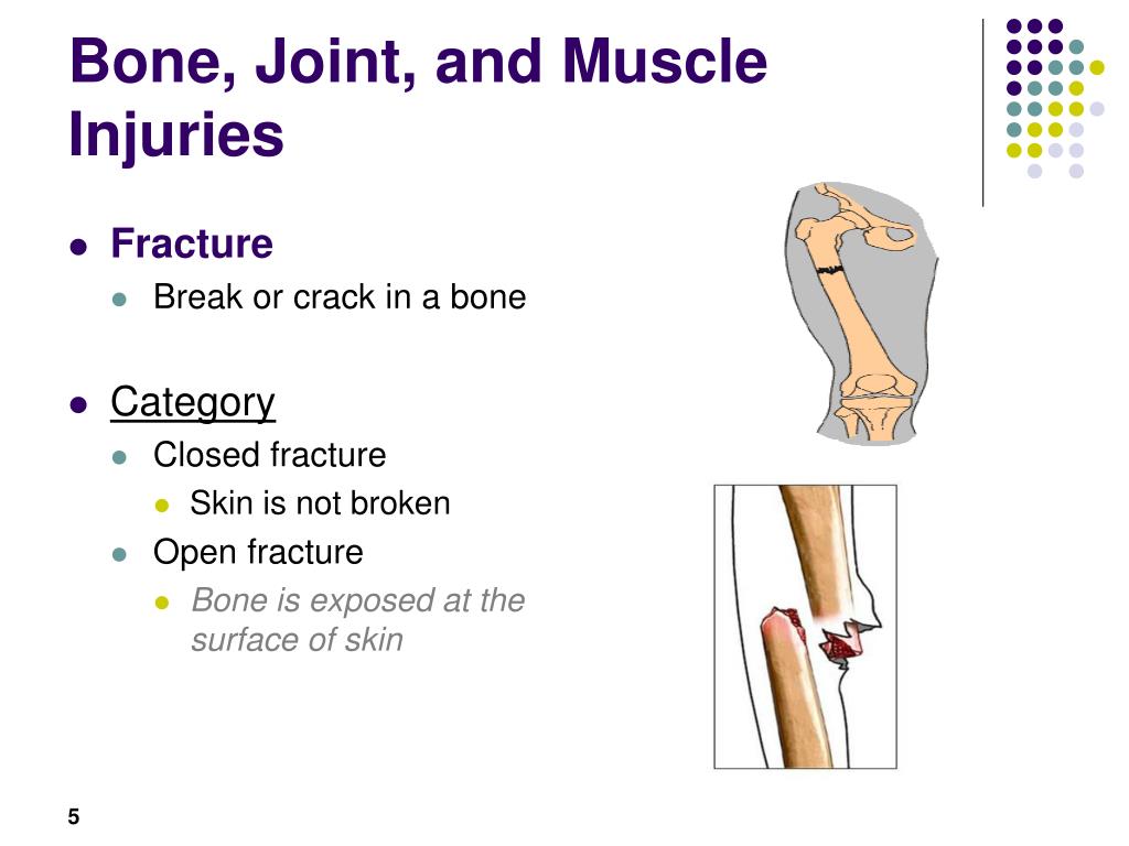 Bones and muscles. Bone Joint muscle injuries. Задания на тему injuries. Bones and Joints for Kids.