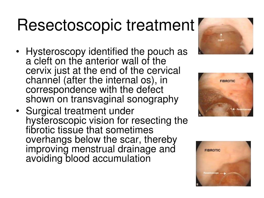 PPT Cesarean Section Scar Defects (CSDs) PowerPoint Presentation