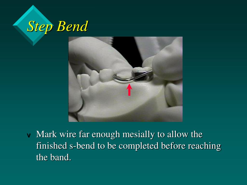Band And Loop Space Maintainer Dental Code at Randall Jacobs blog