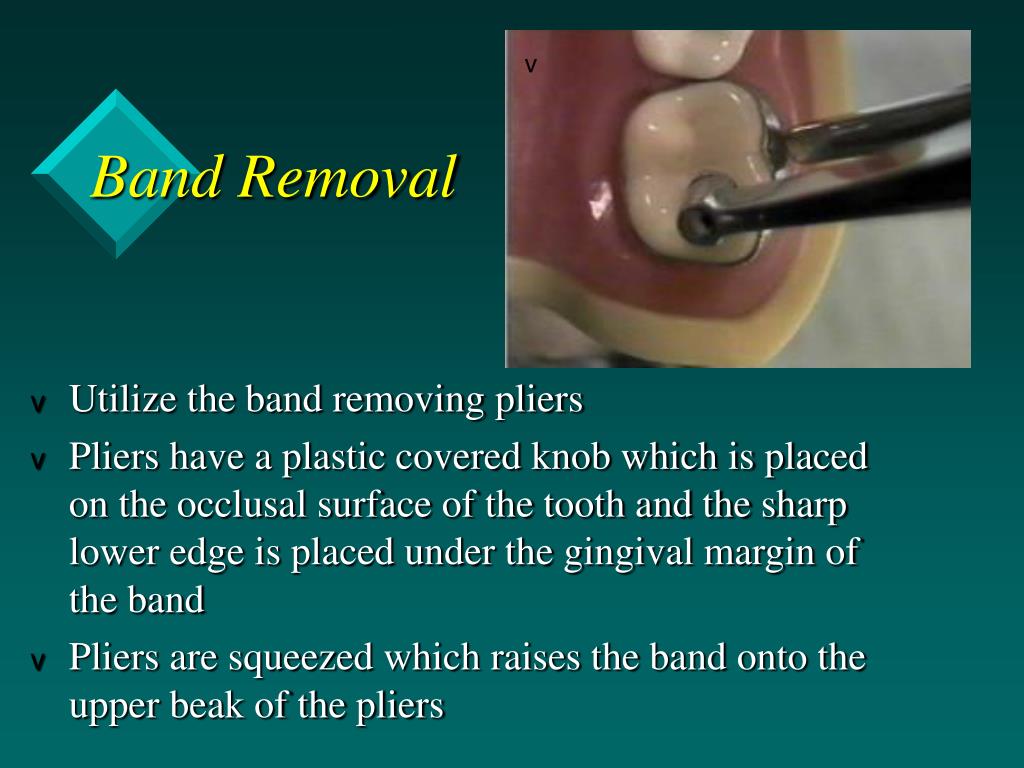PPT Band Loop Space Maintainer PowerPoint Presentation, free download