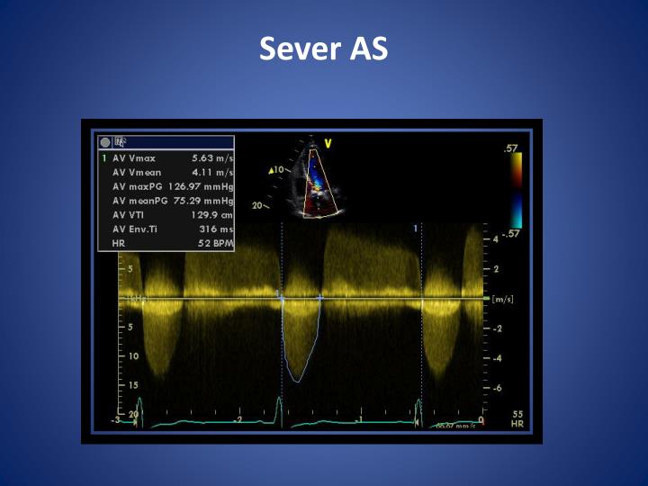 PPT - Echo features of aortic stenosis PowerPoint Presentation - ID:4949845