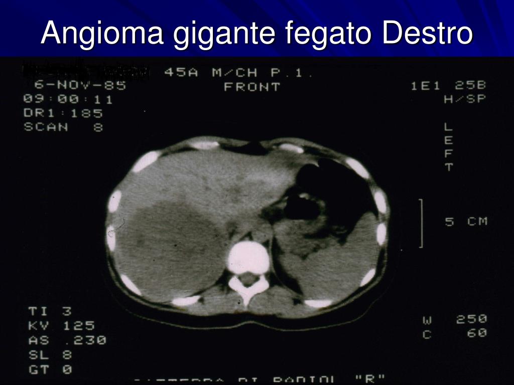 Ppt Malattie Del Fegato 2 L Angioma Gigante Powerpoint