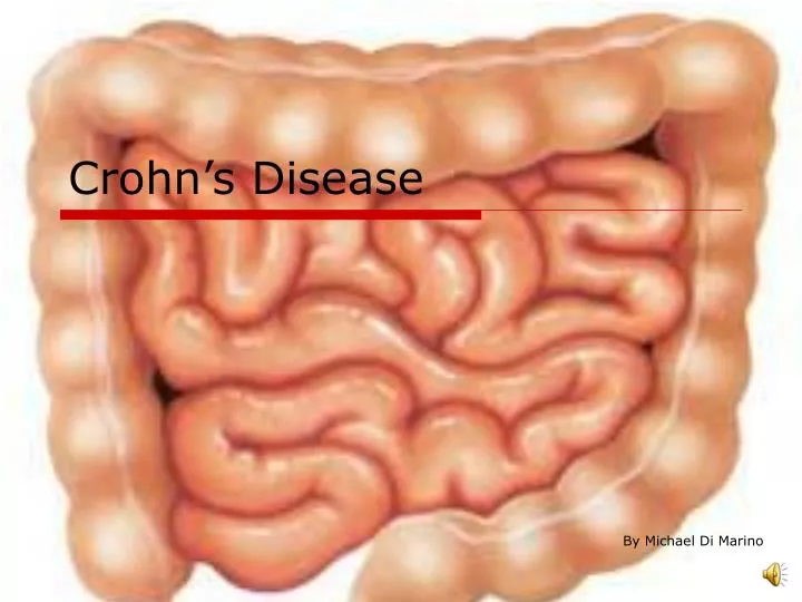 PPT Crohn’s Disease PowerPoint Presentation, free download ID4954621