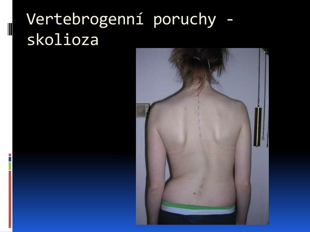 PPT - Vertebrogenní poruchy - skolioza PowerPoint Presentation, free  download - ID:4970731