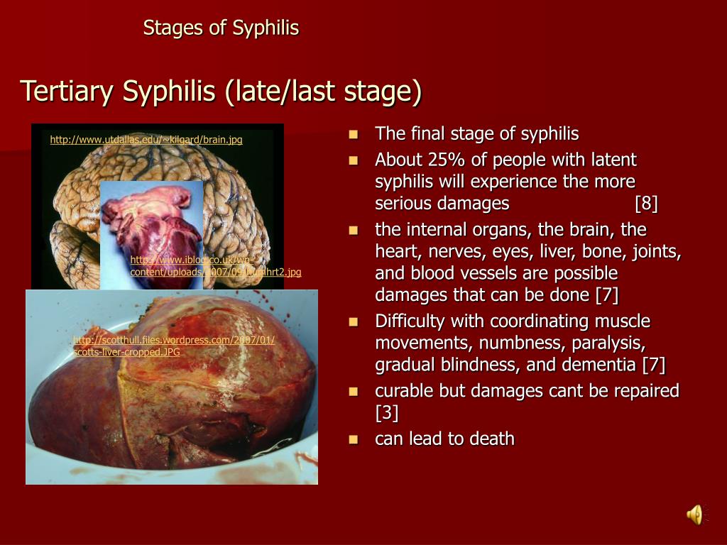 PPT - Syphilis PowerPoint Presentation - ID:4979196