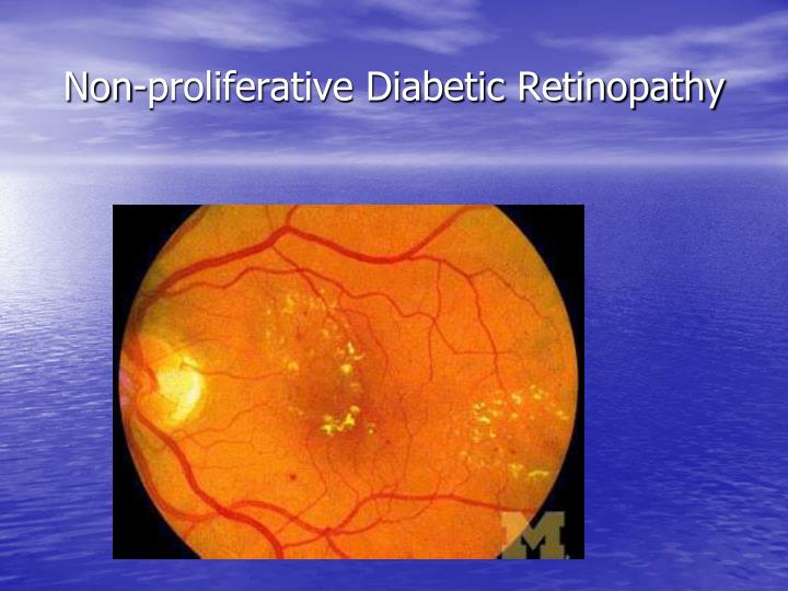 PPT - Diabetic Retinopathy PowerPoint Presentation - ID:4983768