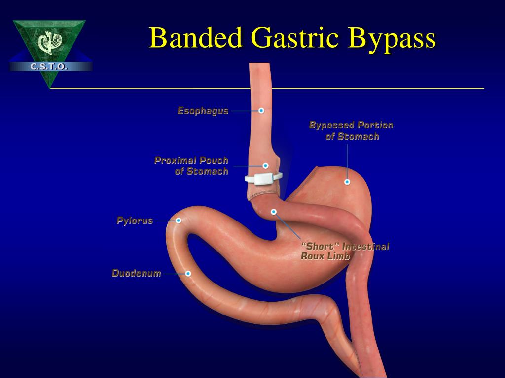 dealer volgens gelijkheid PPT - Who Would H ave Thought It ? Banded Gastric Bypass Works! PowerPoint  Presentation - ID:4999954