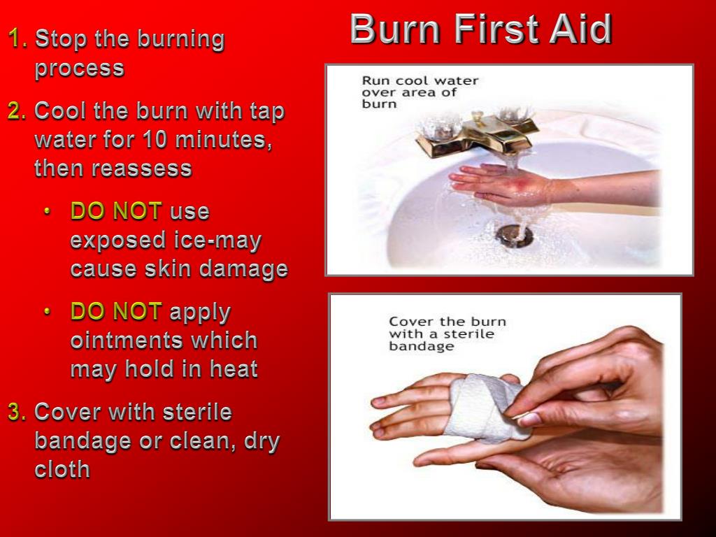 first aid burns powerpoint presentation