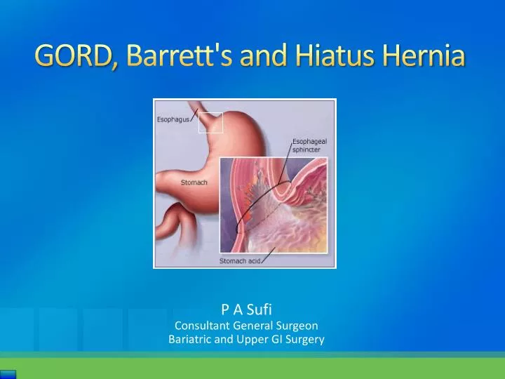 gord barrett s and hiatus hernia n.