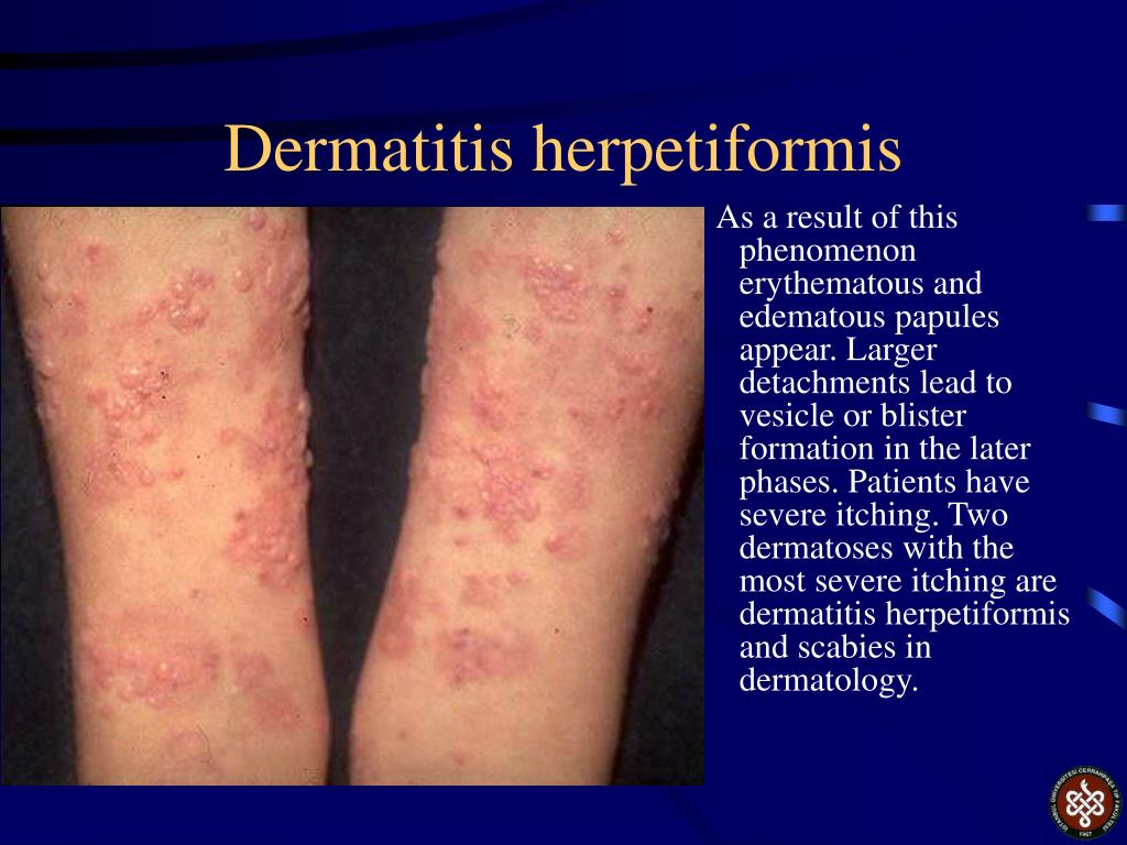 PPT Autoimmune Blistering Diseases PowerPoint Presentation Free PPT Autoimmune Blistering Diseases PowerPoint Presentation Free
