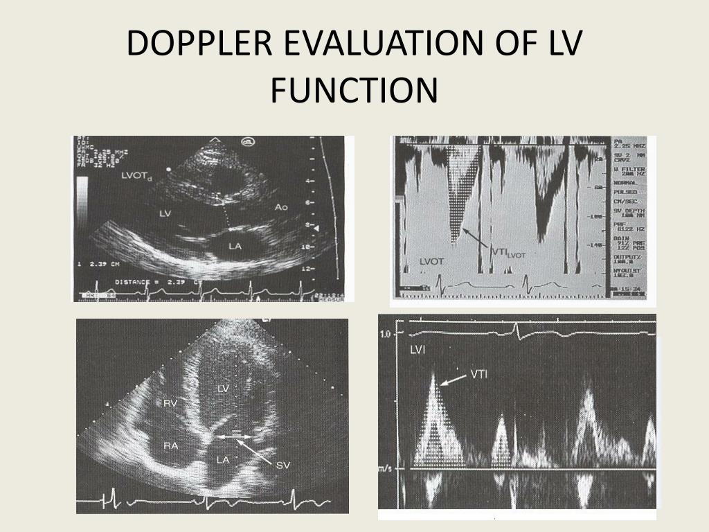PPT - EVALUATION OF SYSTOLIC FUNCTION OF LEFT VENTRICLE BY ECHOCARDIOGRAPHY PowerPoint ...