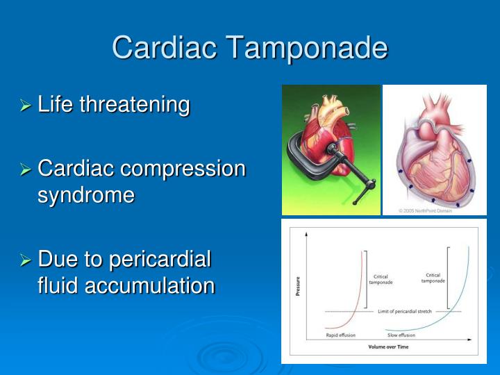 PPT Cardiac Tamponade PowerPoint Presentation ID5026067