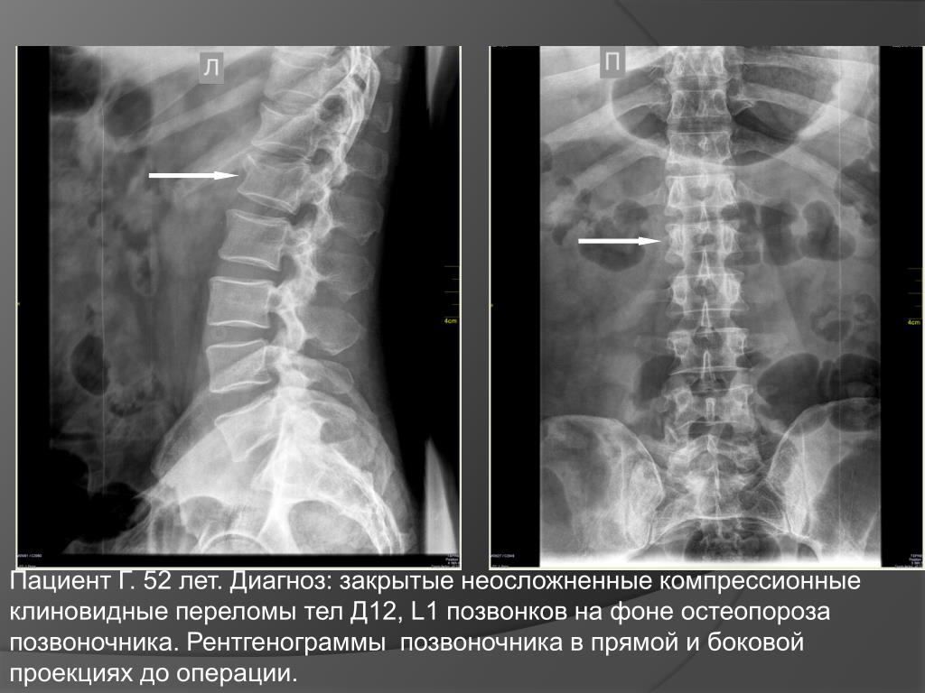 Л 12 диагноз. Что такое компрессионный перелом позвонка клиновидный l 1. Компрессионный перелом позвоночника l12. Компрессионный перелом позвоночника остеопороз рентген. Клиновидный компрессионный перелом позвоночника l1.
