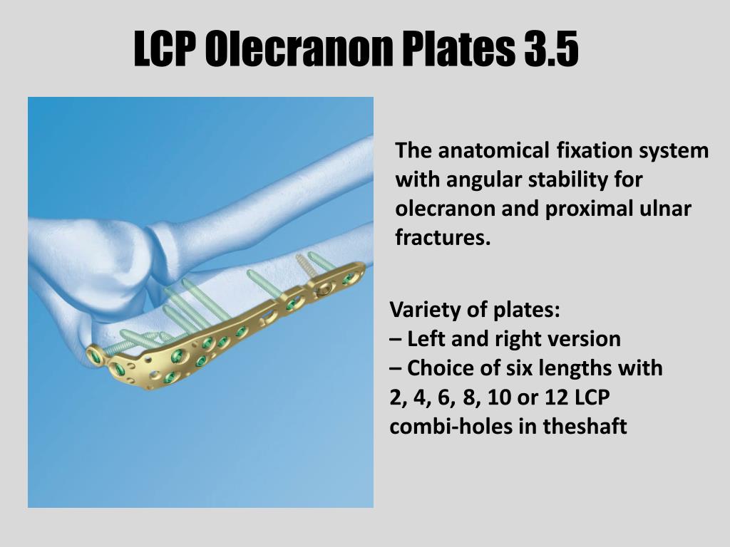 PPT - LCP Olecranon Plates 3.5 PowerPoint Presentation - ID:5031093