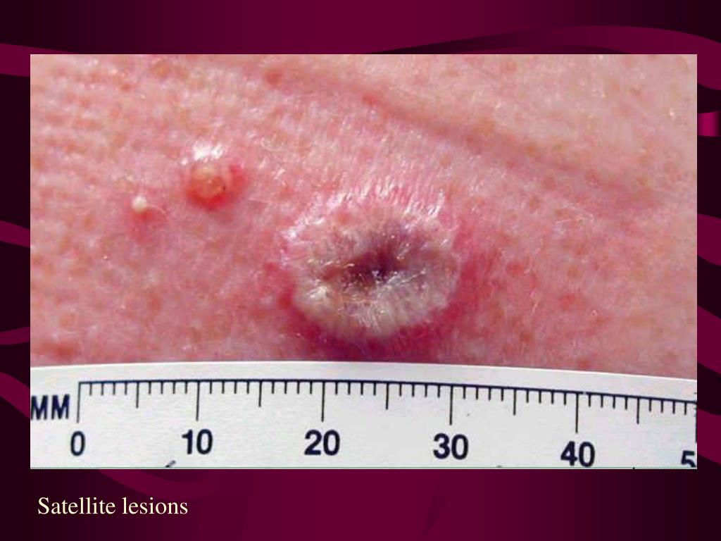 PPT - Smallpox: Risks of Vaccination Patricia Lee MD PowerPoint ...